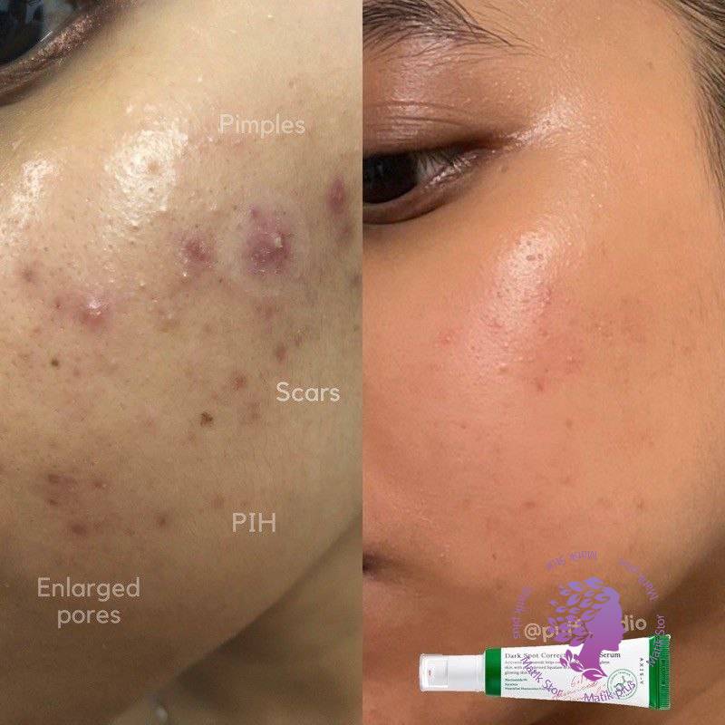 سرم مدل دارک اسپات ضد لک و روشن کننده و از بین برنده جای جوش